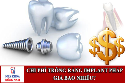 chi phí trồng răng implant pháp giá bao nhiêu