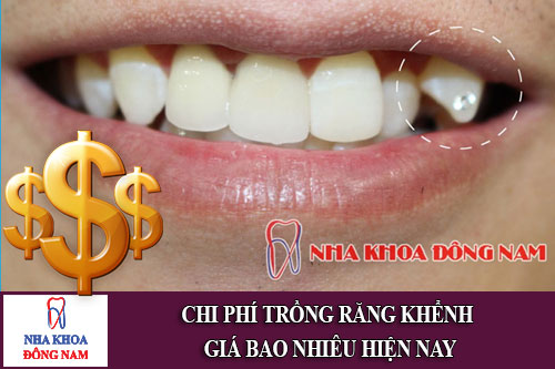 chi phí trồng răng khểnh giá bao nhiêu hiện nay