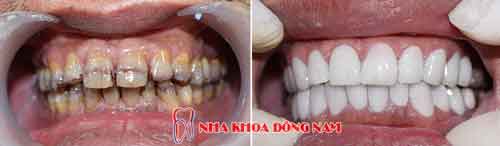 dán răng sứ 2 hàm -07112016