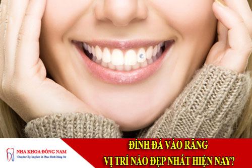 đính đá vào răng vị trí nào đẹp nhất hiện nay