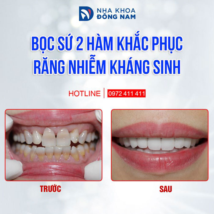 Cách làm răng thỏ tại nhà: Hướng dẫn chi tiết và an toàn