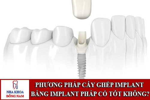 phương pháp cấy ghép implant bằng implant pháp có tốt không
