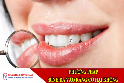 phương pháp đính đá vào răng có hại không