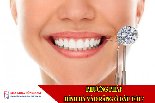 phương pháp đính đá vào răng ở đâu tốt nhất hiện nay