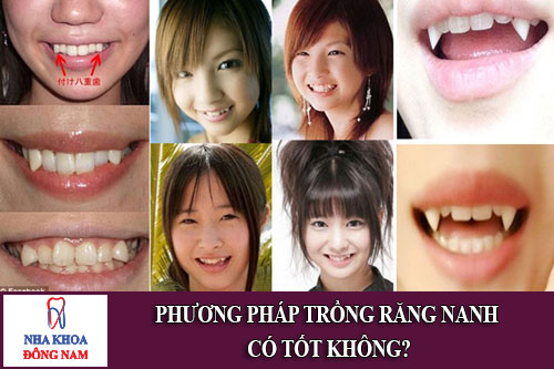phương pháp trồng răng nanh có tốt không