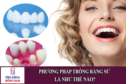phương pháp trồng răng sứ là như thế nào 1