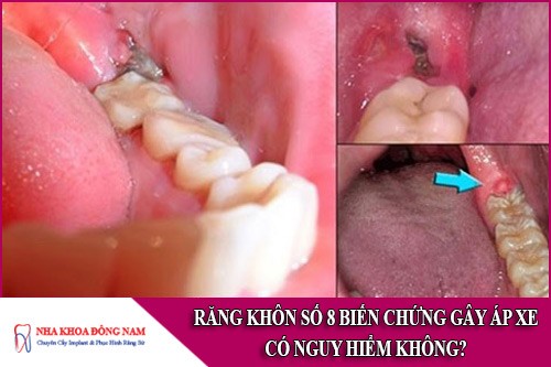 răng khôn số 8 biến chứng gây áp xe có nguy hiểm không