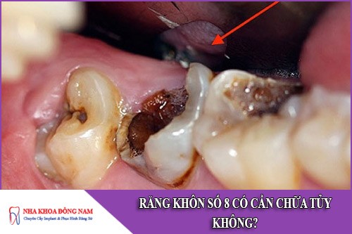 răng khôn số 8 có cần phải chữa tủy không