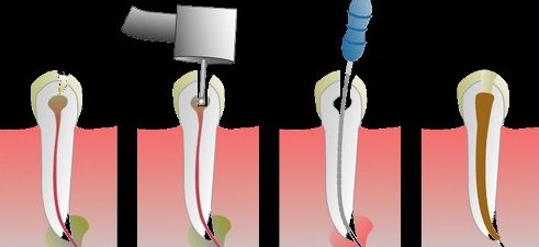 răng khôn số 8 có cần phải chữa tủy không 2