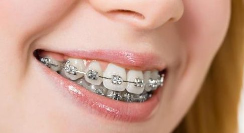 sau khi niềng răng, răng bị “chạy” là do đâu 1