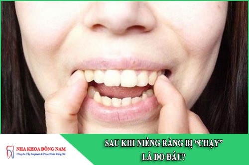 sau khi niềng răng bị chạy là do đâu