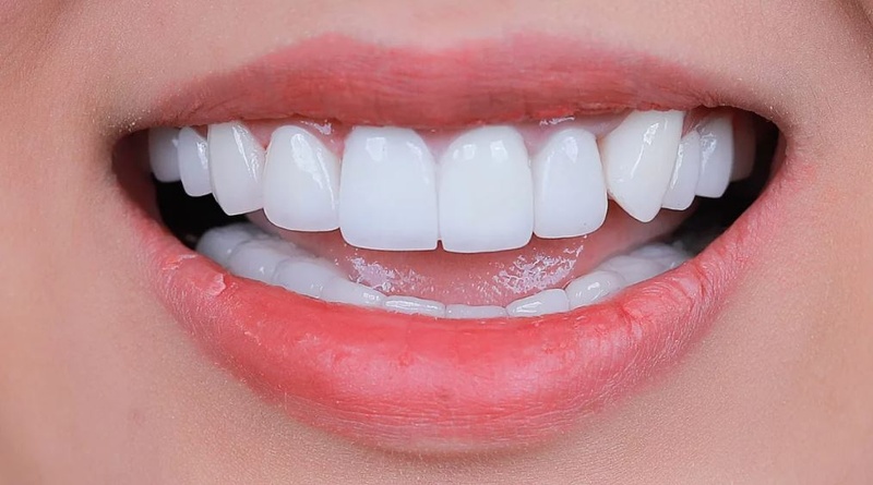 Trồng răng khểnh bằng bọc sứ mang lại thẩm mỹ hoàn hảo