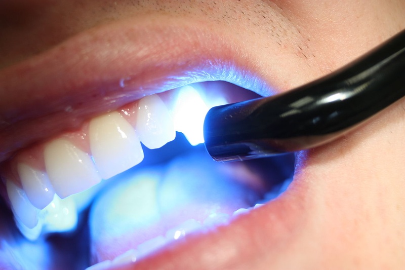 Trồng răng khểnh bằng cách đắp Composite