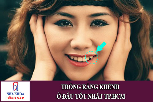 trong-rang-khenh-o-dau-tot-nhat-tphcm
