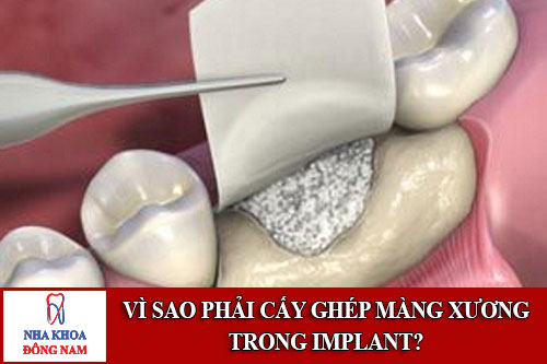 vì sao phải cấy ghép màng xương trong implant