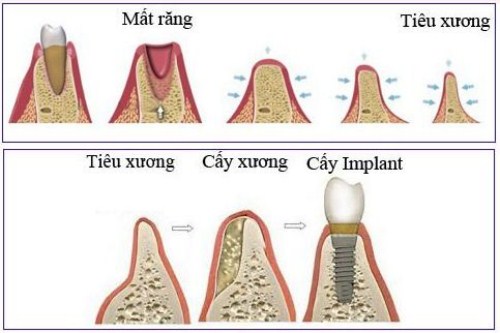 Tiêu xương hàm có cấy ghép implant được không 2