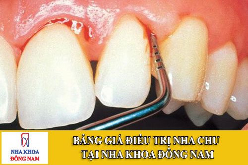 bảng giá điều trị nha chu tại nha khoa đông nam
