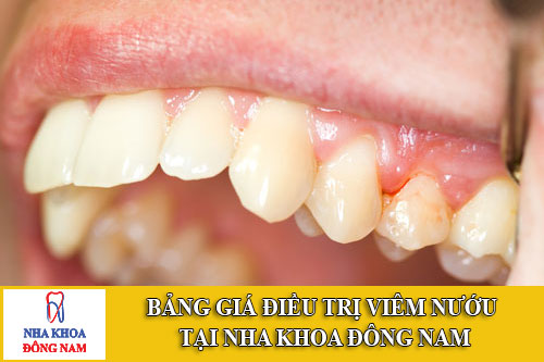 bảng giá điều trị viêm nướu tại nha khoa đông nam