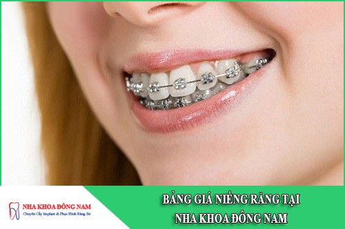 bảng giá niềng răng tại nha khoa đông nam