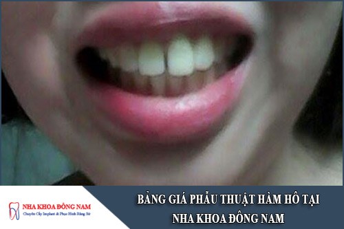 bảng giá phẫu thuật hàm hô tại nha khoa đông nam