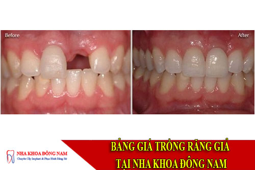 bảng giá trồng răng giả tại nha khoa đông nam