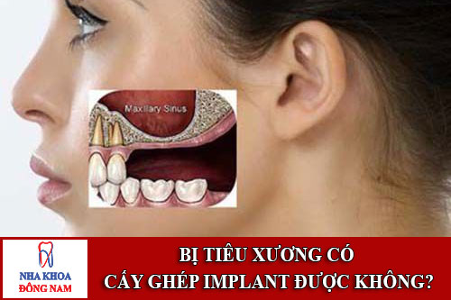 bị tiêu xương có cấy ghép implant được không