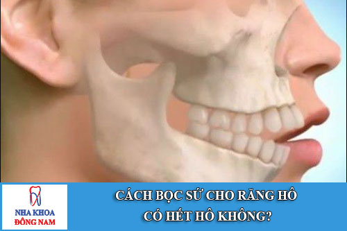cách bọc sứ cho răng hô có hết hô không?