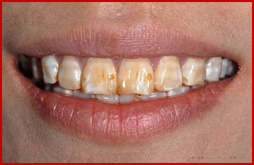 tooth enamel and fluoride How to restore tooth enamel over time brushing your teeth twice a day with a fluoride toothpaste may help restore enamel or prevent further loss of it. tooth enamel and fluoride How to restore tooth enamel over time brushing your teeth twice a day with a fluoride toothpaste may help restore enamel or prevent further loss of it.