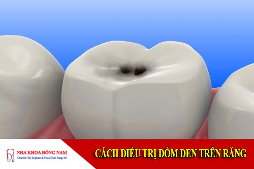 cách điều trị đốm đen trên răng cách điều trị đốm đen trên răng