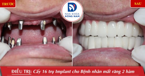 cấy ghép 2 hàm răng implant