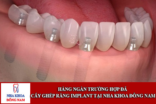 hàng ngàn trường hợp cấy ghép răng implant tại nha khoa đông nam