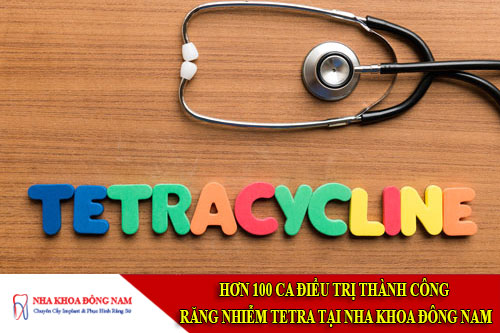 hơn 100 ca điều trị thành công răng nhiễm tetra tại nha khoa đông nam