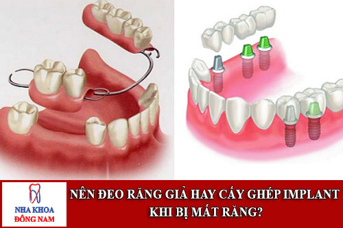 nên đeo răng giả hay cấy ghép implant khi bị mất răng