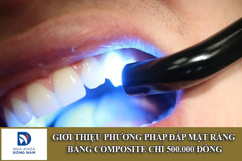 phương pháp đắp mặt răng bằng composite chỉ 500.000 đồng