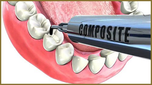 phương pháp đắp mặt răng bằng composite chỉ 500.000 đồng 1