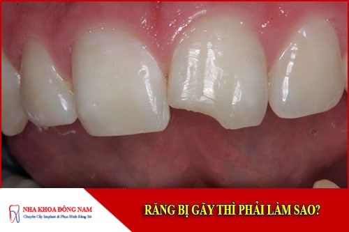 răng bị gãy thì phải làm sao