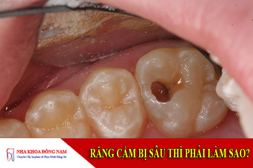 răng cấm bị sâu thì phải làm sao?