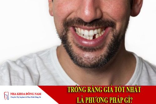 trồng răng giả tốt nhất là phương pháp gì