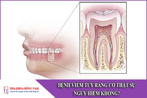 bệnh viêm tủy răng có thật sự nguy hiểm không
