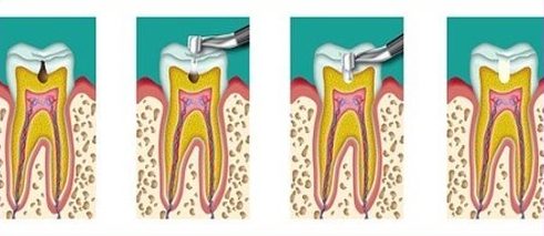 bệnh viêm tủy răng có thật sự nguy hiểm không 2