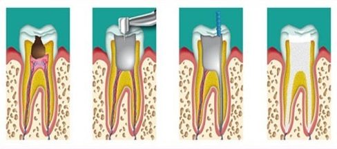 bệnh viêm tủy răng có thật sự nguy hiểm không 3