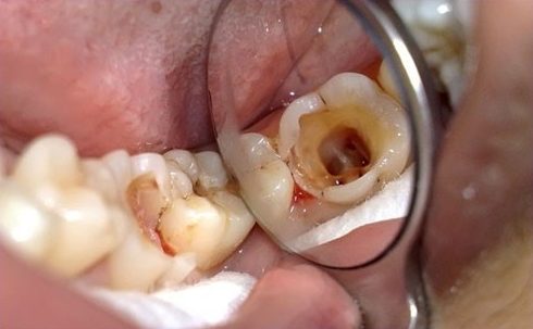 bệnh viêm tủy răng có thật sự nguy hiểm không