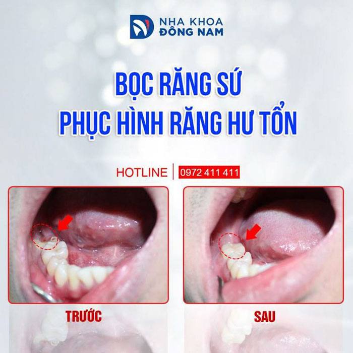 Bọc răng sứ phục hình răng hàm bị hư tổn nặng