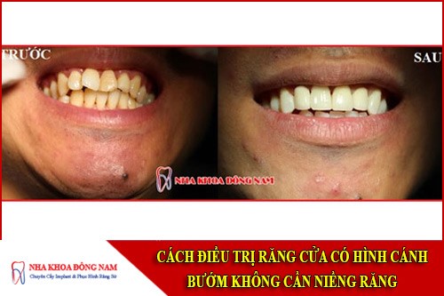 cách điều trị răng cửa có hình cánh bướm không cần niềng răng