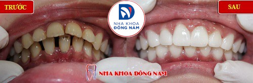 cách điều trị răng cửa bị hô không cần phải nhổ 2