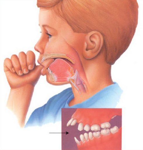 cách điều trị răng cửa bị hô không cần phải nhổ 1