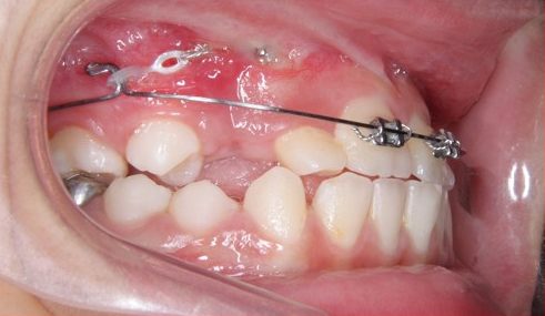 cách điều trị răng cửa bị hô không cần phải nhổ 3