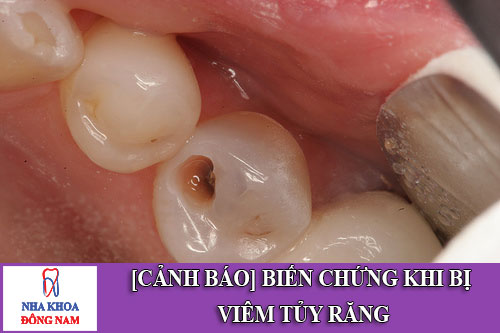 biến chứng khi bị viêm tủy