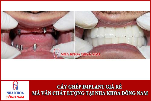 cấy ghép implant giá rẻ mà vẫn chất lượng tại nha khoa đông nam
