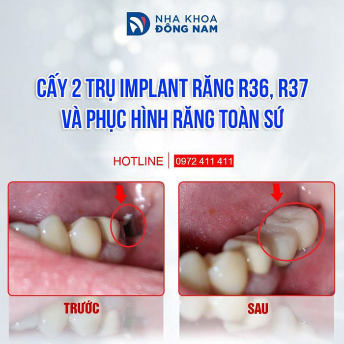 Cấy ghép Implant là phương pháp trồng răng giả hiệu quả nhất hiện nay